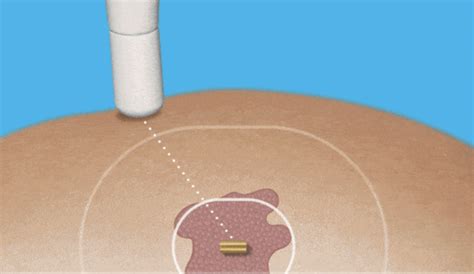 wire guided localization breast